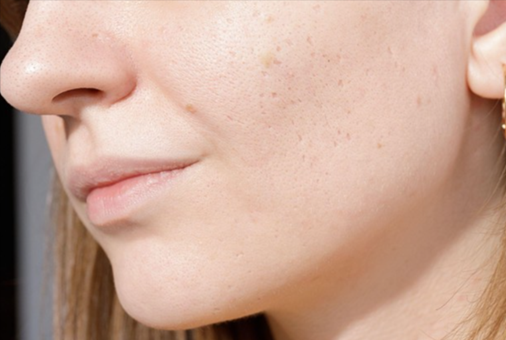 Deep vs Shallow Scars